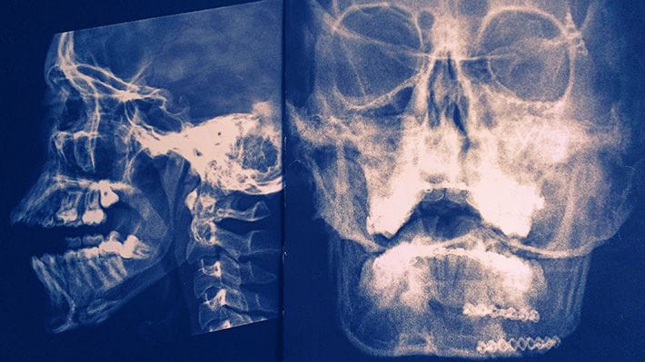 X-rays of my face from 2003
