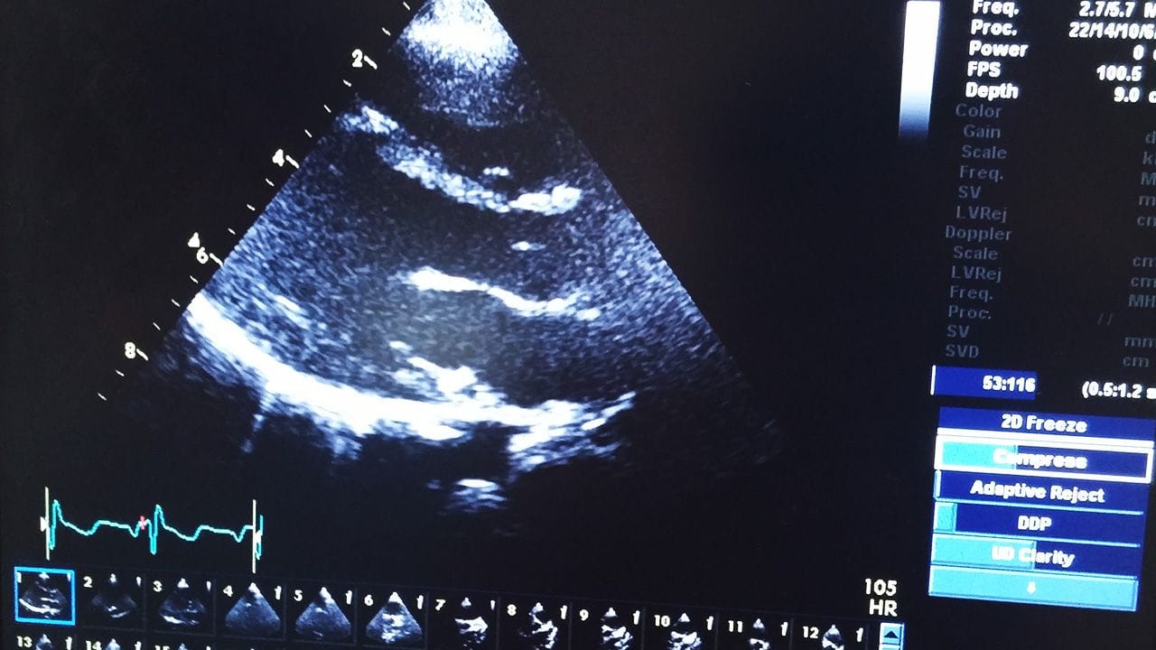 Lucien Eriksson and his echocardiogram.